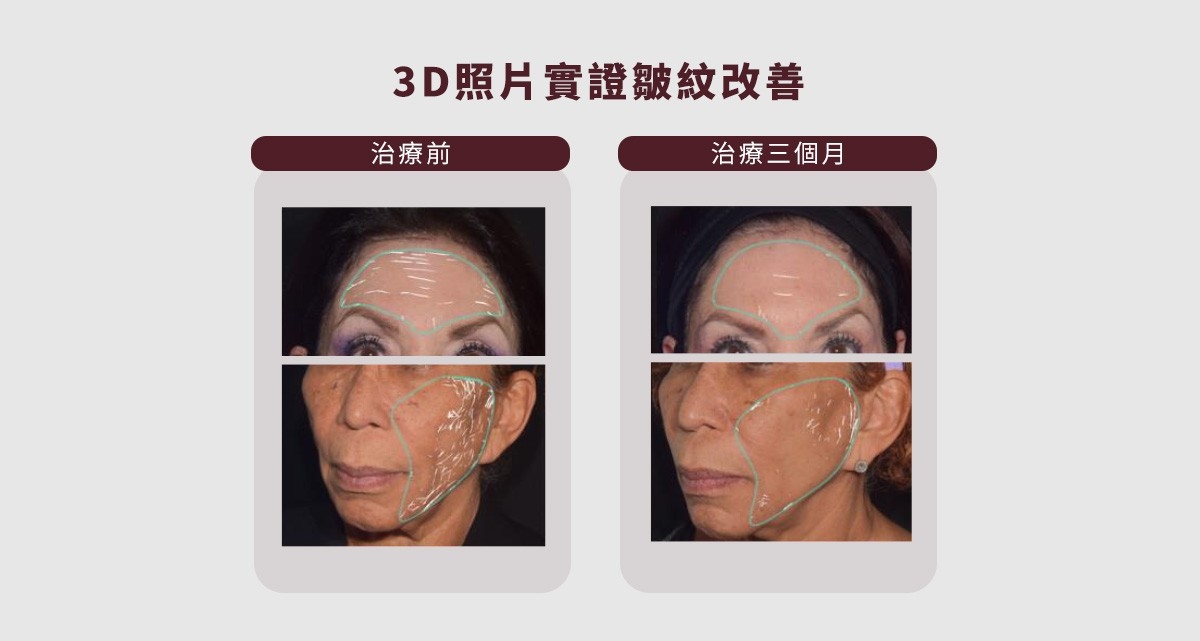 安珀琢玉 Emface 臉部拉提 菲斯波